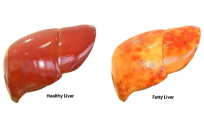 Everything about Fatty Liver Disease